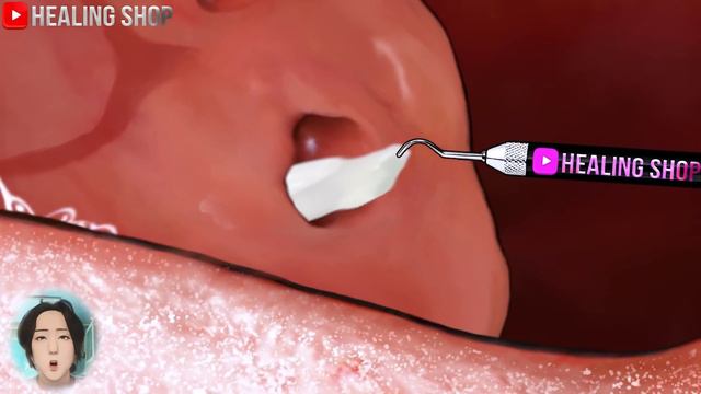 [ASMR]Clean!Oral Stones,stomatitis, Tongue Needles, Tonsillitis Treatment Animation Asmr/without Ca