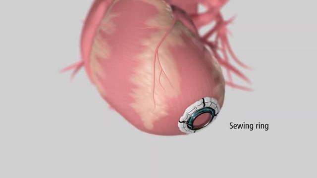 Medical Device Animation: Heartware System LVAD Pump