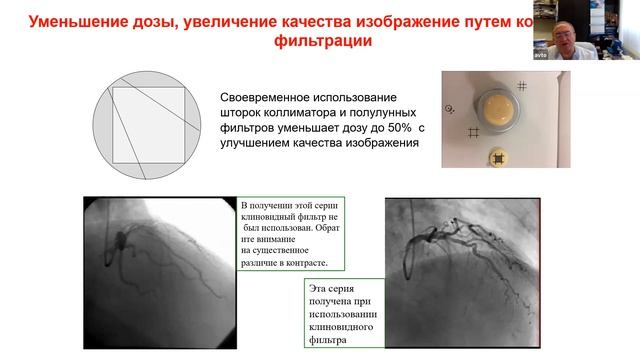 Радиационная безопасность при рентгенэндоваскулярных методах диагностики и лечения. Бабунашвили А.М