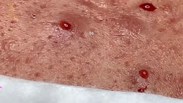 Get Rid Of BLACKHEADS For The LONGEST Time, 44 Minutes (56) | Loan Nguyen