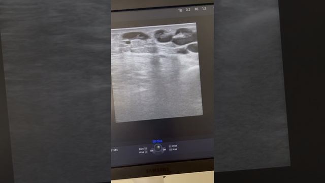 Тромбоз вен. Как лечить тромбоз ? Флеболог Москва. Флеболог. Сосудистый хирург