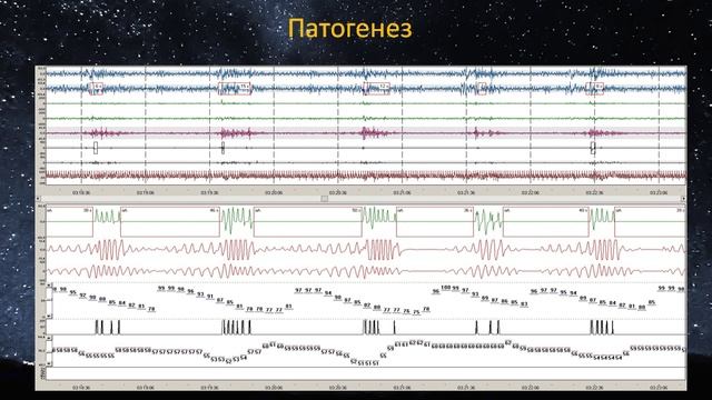 2. Уровни обструкции верхних дыхательных путей. Патогенез апноэ сна.mp4 смотреть онлайн