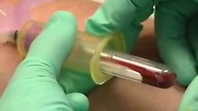 Venipuncture