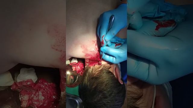 Удаление карбункула спины смотреть онлайн