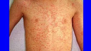 Корь у детей