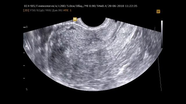 Полип эндометрия. Barto-clinic.ru смотреть онлайн