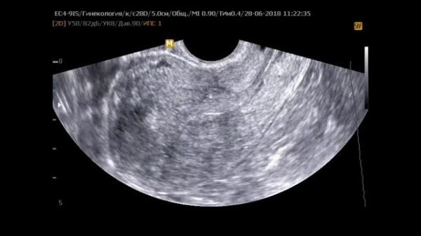 Полип эндометрия. Barto-clinic.ru