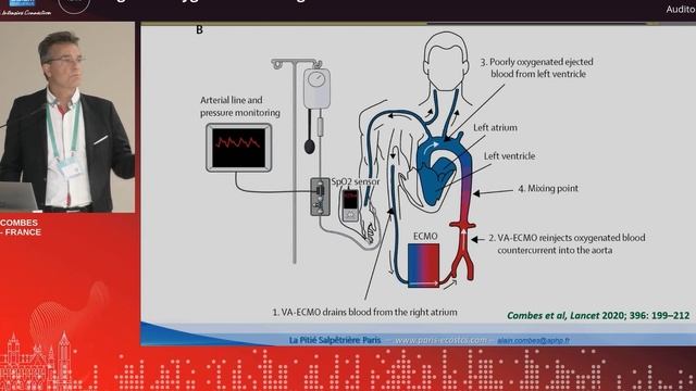 Regional oxygenation during VA-ECMO  A. Combes  (ESICM 23)