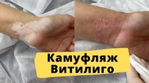 ВИТИЛИГО можно вылечить? Подбор пигментов, процесс камуфляжа витилиго и результат ДО/ПОСЛЕ.