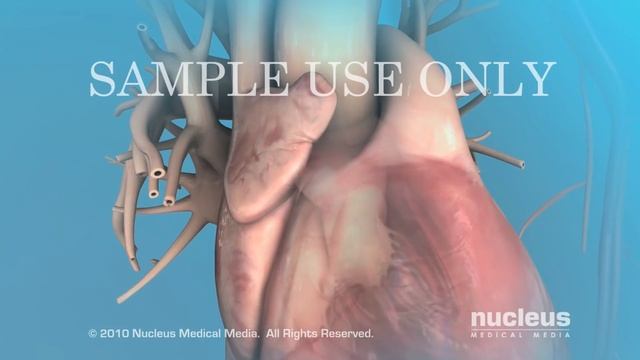 Cardioversion (for Atrial Fibrillation) смотреть онлайн