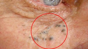 Сальные пробки и чёрные точки! Чего боятся Камедоны