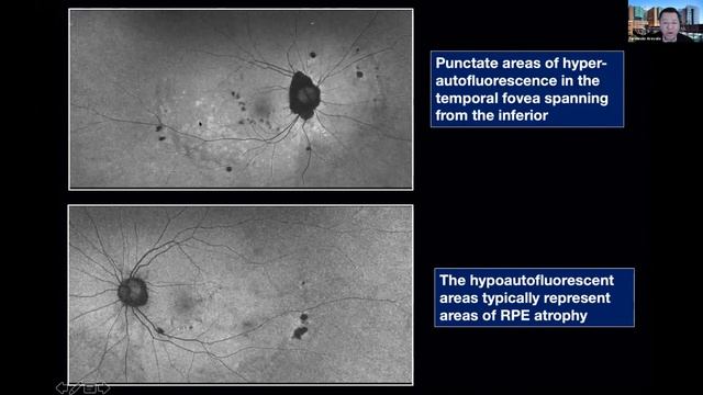 Uveitis Webinar - 4 (Posterior Uveitis) смотреть онлайн
