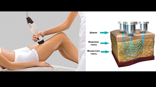 RF-лифтинг. Современная процедура моделирования тела