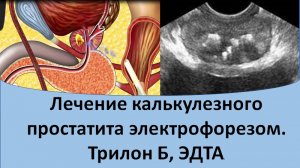 Лечение калькулезного простатита электрофорезом. Трилон Б, ЭДТА.