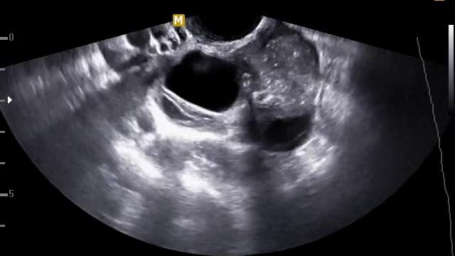 Дермоидная киста правого яичника смотреть онлайн