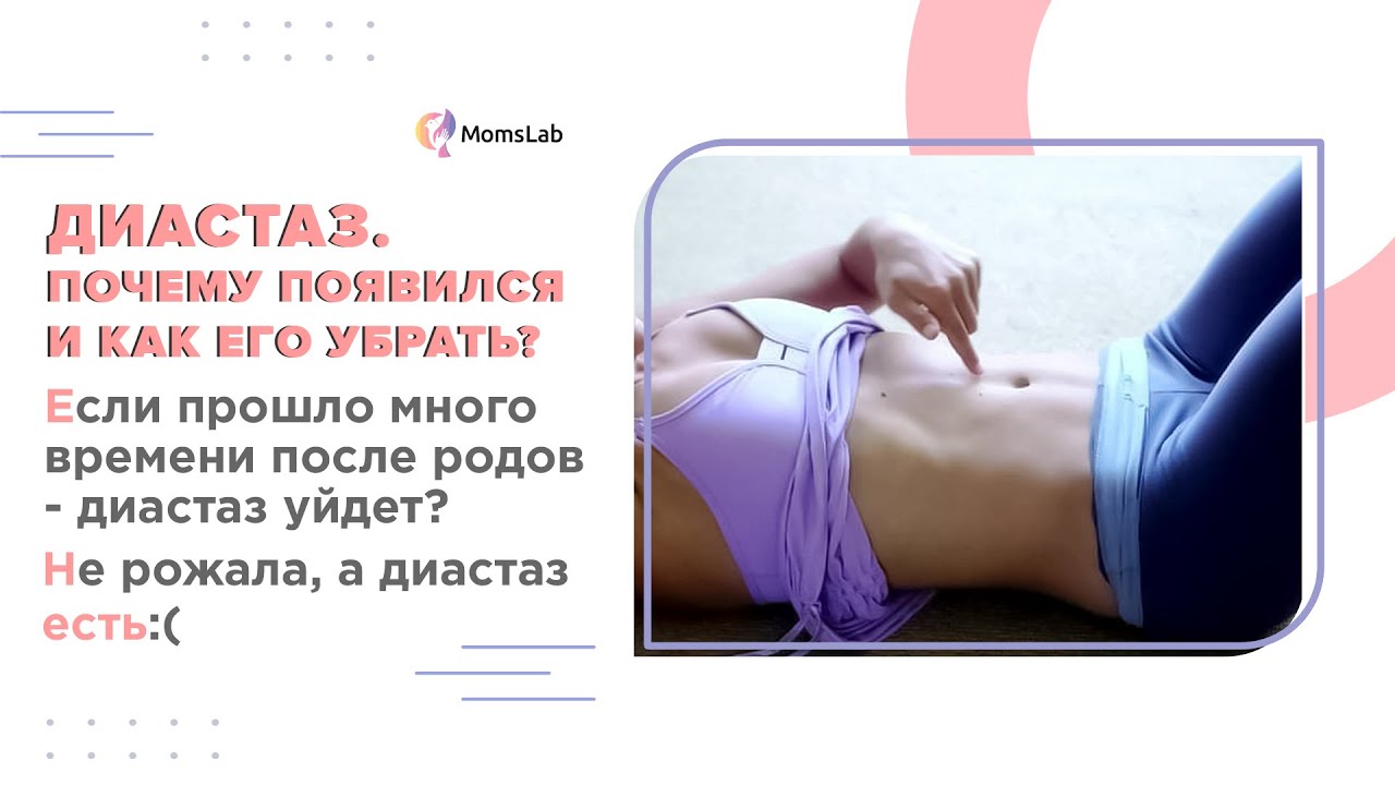 Диастаз после родов или диастаз прямых мышц: что делать, если у вас расхождение прямых мышц живота