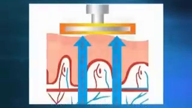 Non-Invasive Face Lift by Radio Frequency(RF) & Body Conturing System- Therma G-Plus смотреть онлайн