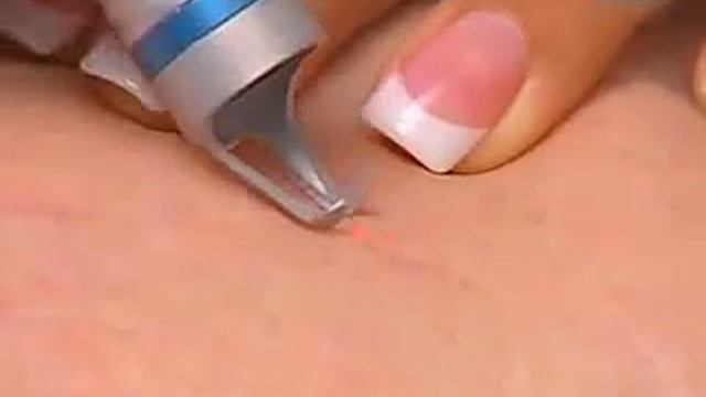 Васкулярный лазер HONKON 980ZX (VASCULAR LASER)