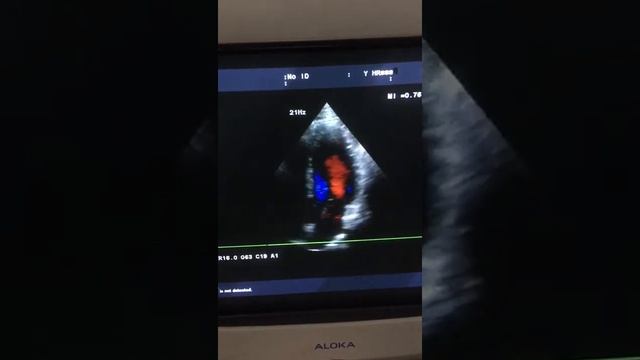 Aloka prosound alpha 10 cardiovascular Japanese ultrasound at good price смотреть онлайн