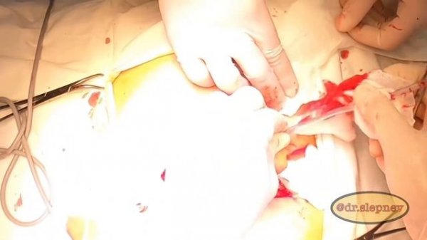 Bascom II (cleft lift).