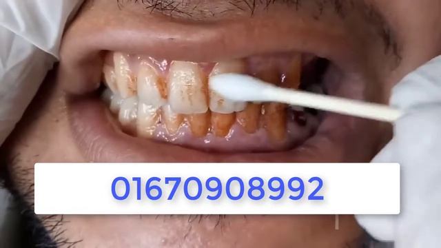 LANBENA TOOTH WHITENING ESSENCE