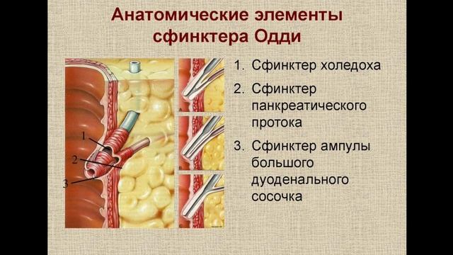Удаление камней из желчных протоков. ЭРХПГ.