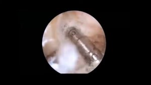 Пластика ПКС (передней крестообразной связки) и шов мениска. http://www.artro-s.ru/