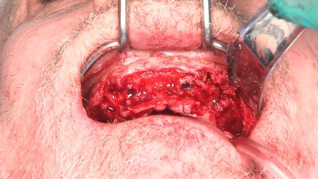 United Smile Center March 22, 2013 All on 4 Part 2 смотреть онлайн