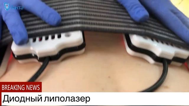 Лазерная липосакция смотреть онлайн