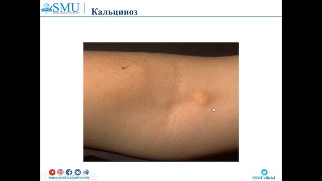 дерматомиозит полимиозит русский вариант смотреть онлайн