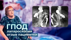 Гигантская грыжа пищевода - история пациентки | Лапароскопия | Проведение операции