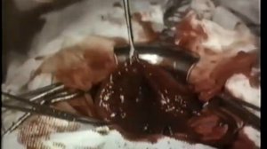 Корпоральное кесарево сечение © Corporeal cesarean section