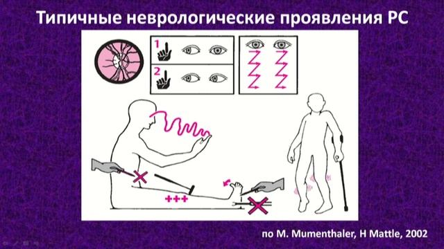 Рассеянный склероз. Часть 1 (Multiple Sclerosis. Part 1)