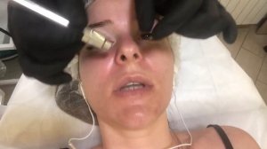 Алмазный пилинг, микродермабразия