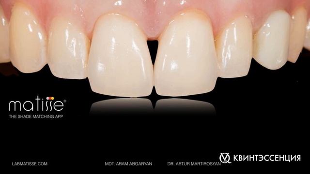 Курс Арама Абгаряна "Стоматология – это окклюзия.Функциональное размыкание зубов по М. Кувате (FDO) смотреть онлайн