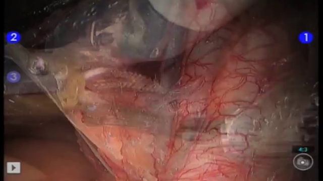 Robotic Pelvic Lymph Node Dissection by Dr Geoff Coughlin смотреть онлайн