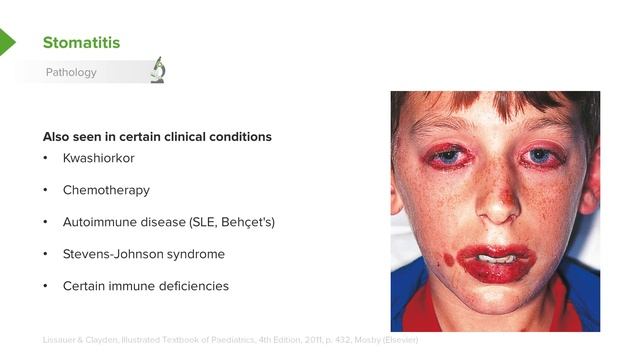 Stomatitis (Oral Mucositis) – Pediatric Infectious Diseases | Lecturio смотреть онлайн