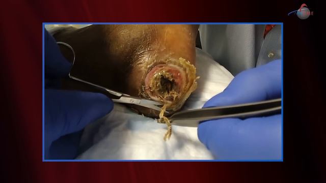 WCW: Natural Maggot Therapy