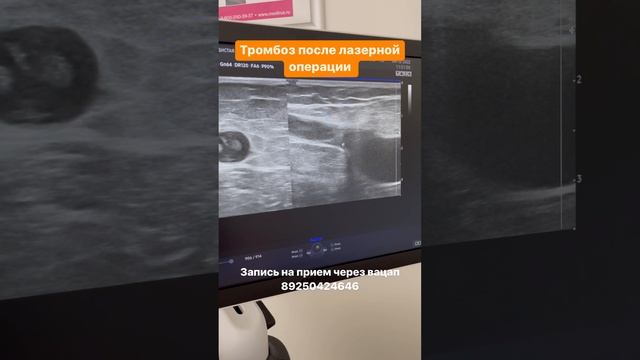 Тромбоз после лазерной операции по удалению варикозной вены. Флеболог Москва. Флеболог смотреть онлайн