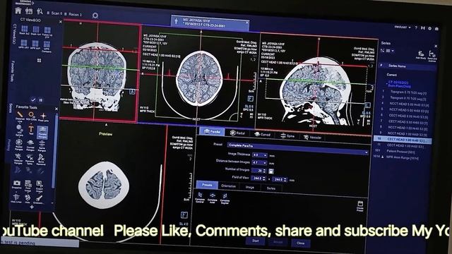 CECT BRAIN | ct Scan of the head | Siemens | 96 slice | 16 slice | Video | plain with Contrast head смотреть онлайн