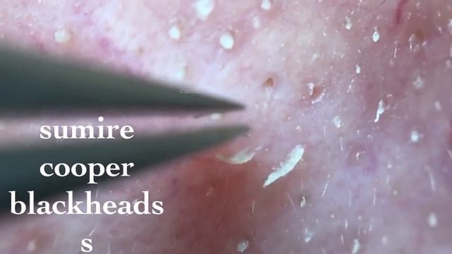 鼻角栓107.2nose Blackheads（Larger Version）★Tweezers Only★