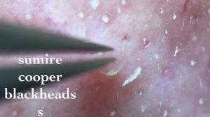 鼻角栓107.2nose blackheads（Larger version）★Tweezers only★