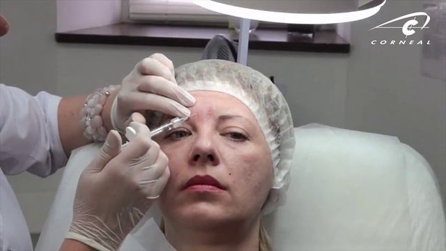 Болюсно корректируем межбровную складку смотреть онлайн