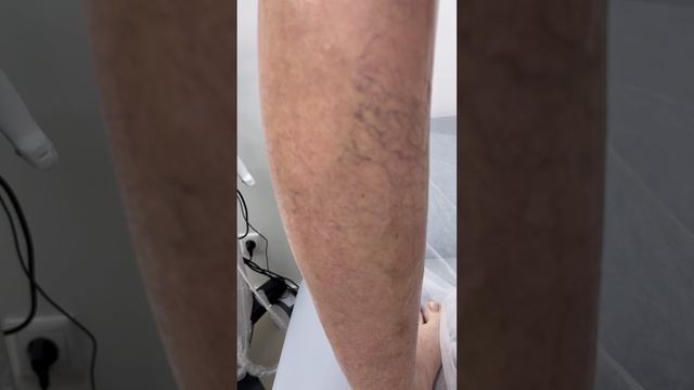 Как лечить варикоз? Сосудистая сетка. Лечение вен. Склеротерапия. Флеболог Москва смотреть онлайн