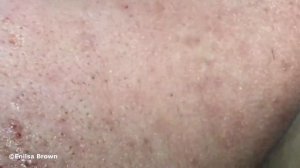 "K" Blackhead Extractions