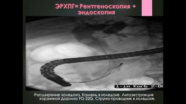 Желчнокаменная болезнь , лечение , диагностика , прогноз