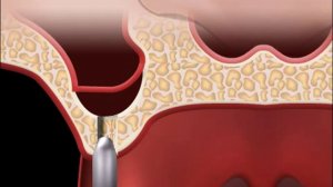 Что такое Синус -лифтинг?