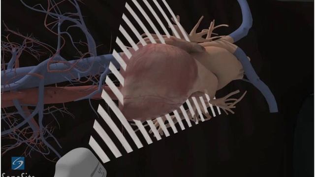 3D Comment: Vue Apicale 4-Cavités, Echocardiographie - échographe SonoSite смотреть онлайн