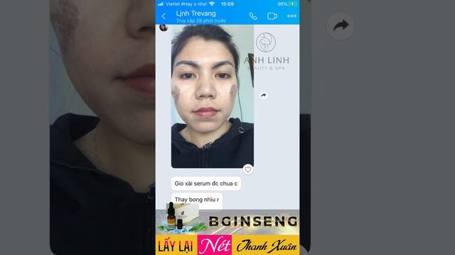 KH16 | Khách Hàng Sử Dụng Thay Da Sinh Học | B-GINSENG PEELING смотреть онлайн