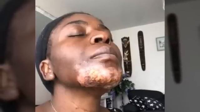 MY TERRIBLE 100% TCA CHAMICAL PEEL / TCA PEEL GONE BAD / MARY'SFABLIFE смотреть онлайн